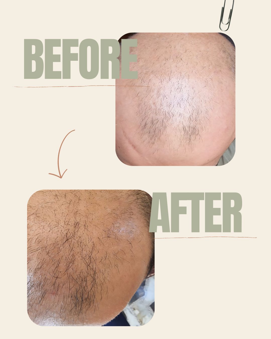 Minoxidil Alternative Hair Mist